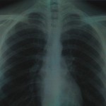 Chest xray/ Credit: Flickr user Aidan_Jones